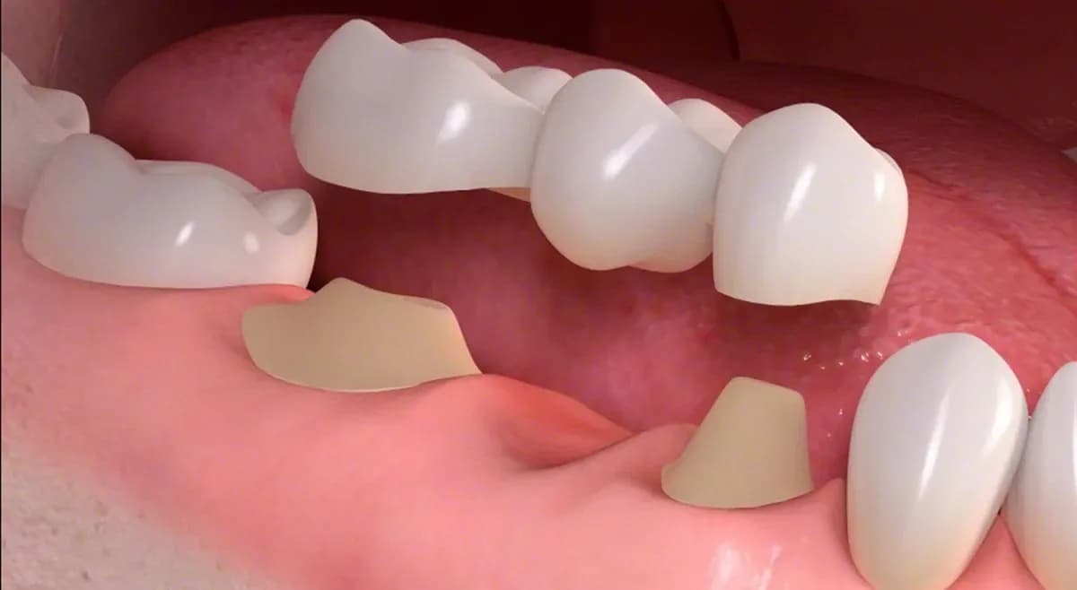 Dental crowns and bridges at London Square Dental Calgary