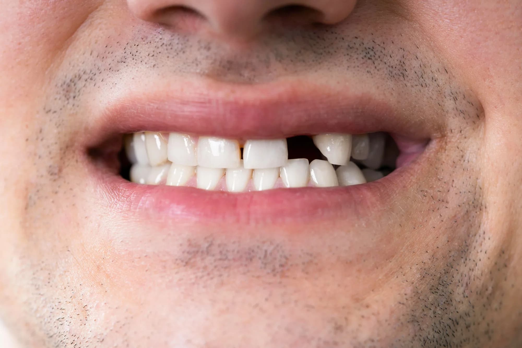 Post-treatment care after root canal
